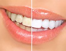 Efekt wybielania zębów - zdrowe i białe zęby