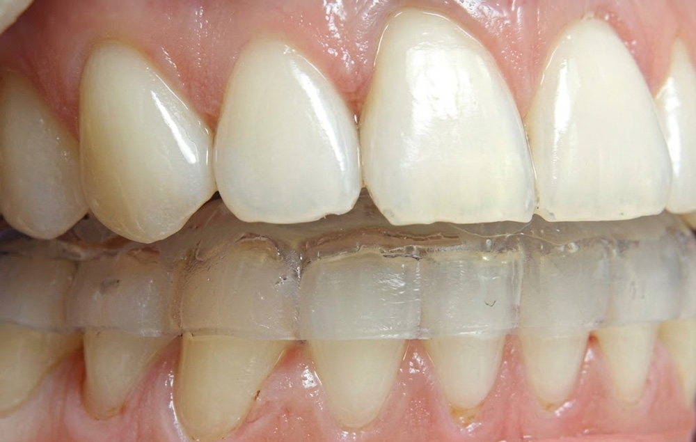 https://www.dentsm.pl/wp-content/uploads/2026/06/Bruksizm_2a.jpg