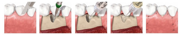https://www.dentsm.pl/wp-content/uploads/2026/06/emdogain_art.jpg