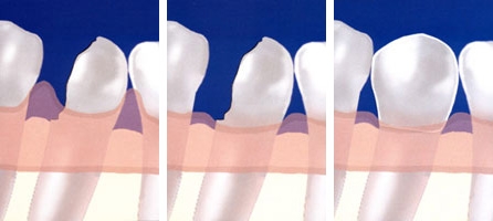 https://www.dentsm.pl/wp-content/uploads/2026/06/estestyczne-wydluzenie-korony-klinicznej_art.jpg