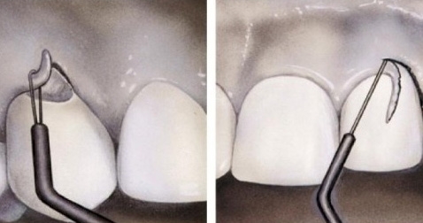 https://www.dentsm.pl/wp-content/uploads/2026/06/gingiwektomia_art.jpg