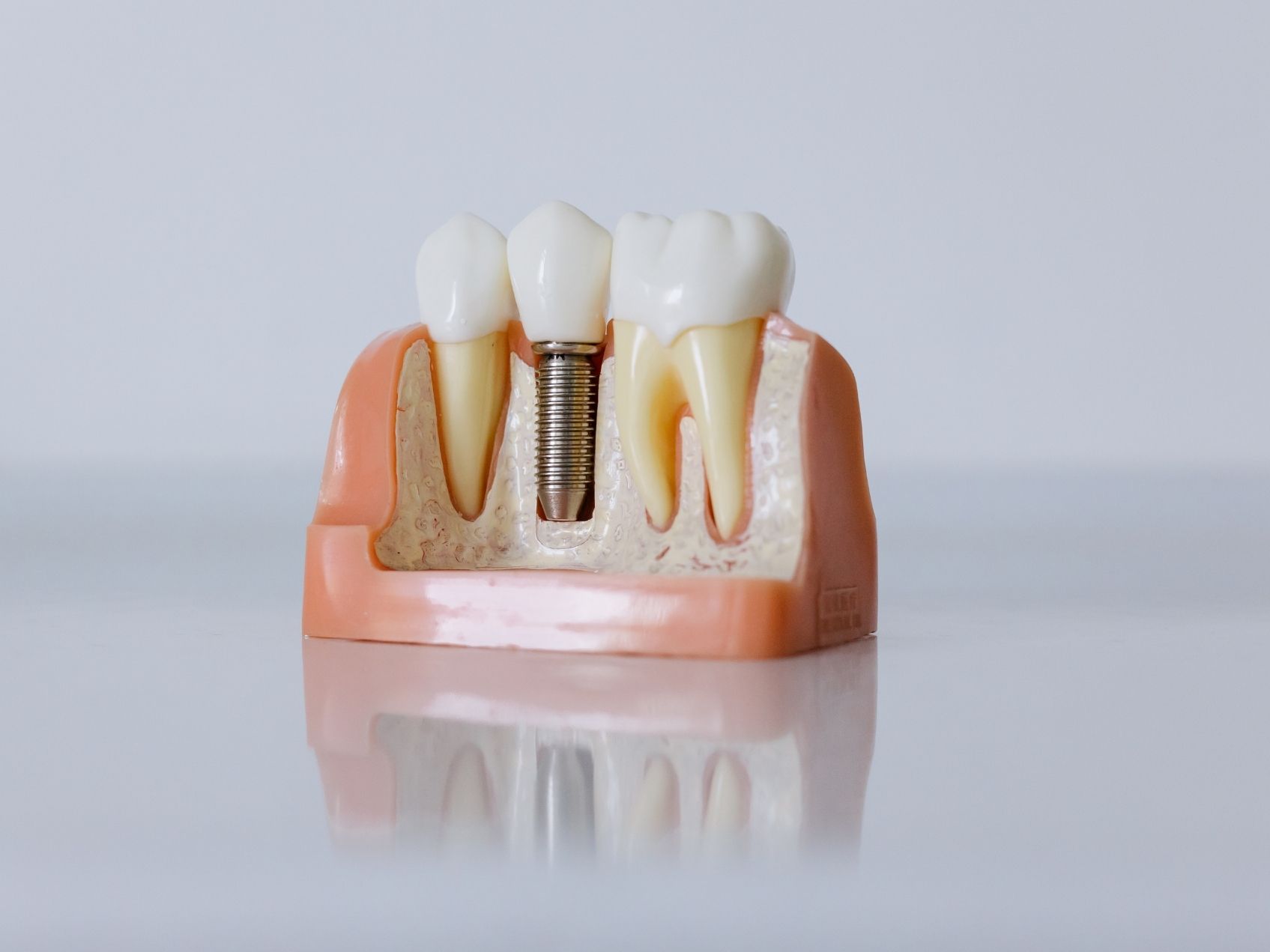 https://www.dentsm.pl/wp-content/uploads/2026/06/implanty.jpg