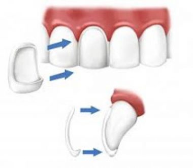 https://www.dentsm.pl/wp-content/uploads/2026/06/licowki-porcelanowe_art_min_th.jpg