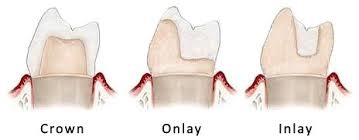 https://www.dentsm.pl/wp-content/uploads/2026/06/naklady-onlay-inlay_art.jpg