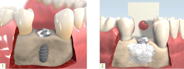 https://www.dentsm.pl/wp-content/uploads/2026/06/rekonstrukcja-kosci-w-implantologii_art.jpg