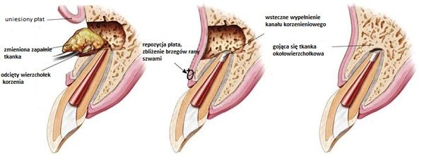 https://www.dentsm.pl/wp-content/uploads/2026/06/resekcja-wierzcholkow-korzenia_art.jpg
