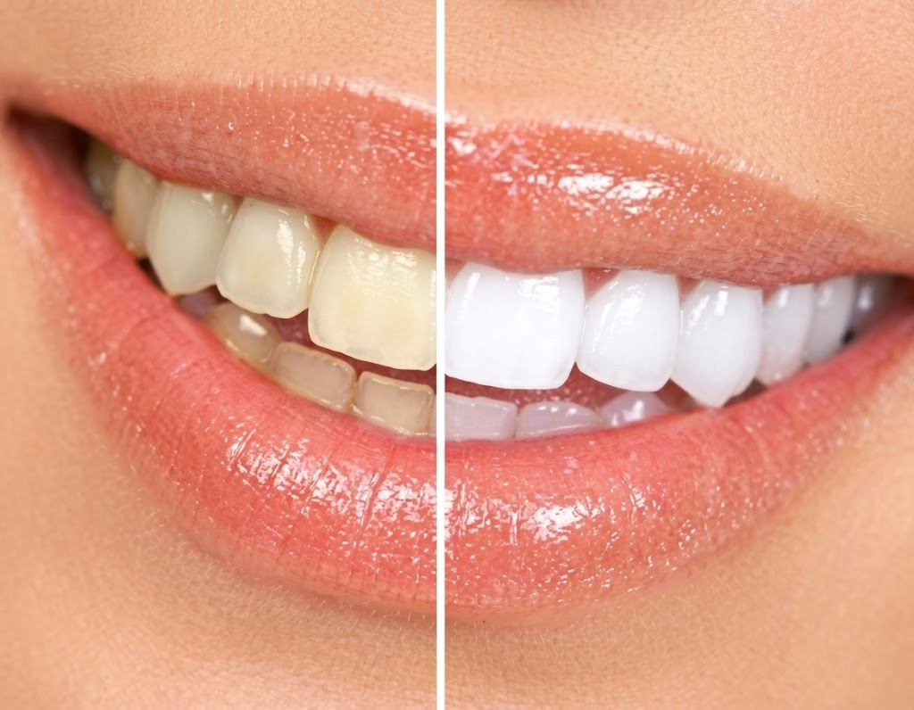 https://www.dentsm.pl/wp-content/uploads/2026/06/wybielanie_3.jpg